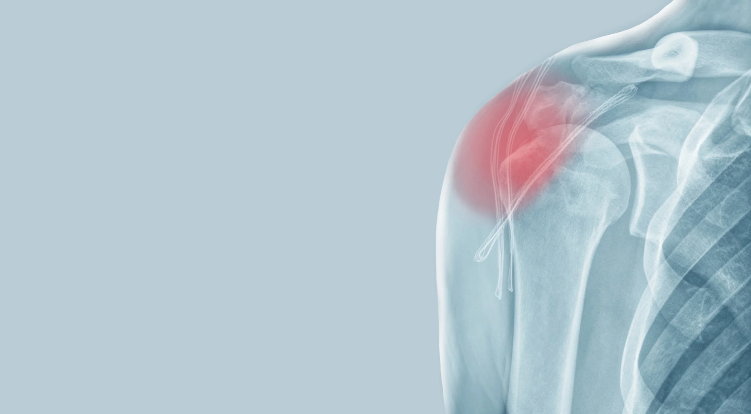 Ανάστροφη ολική αρθροπλαστική ώμου